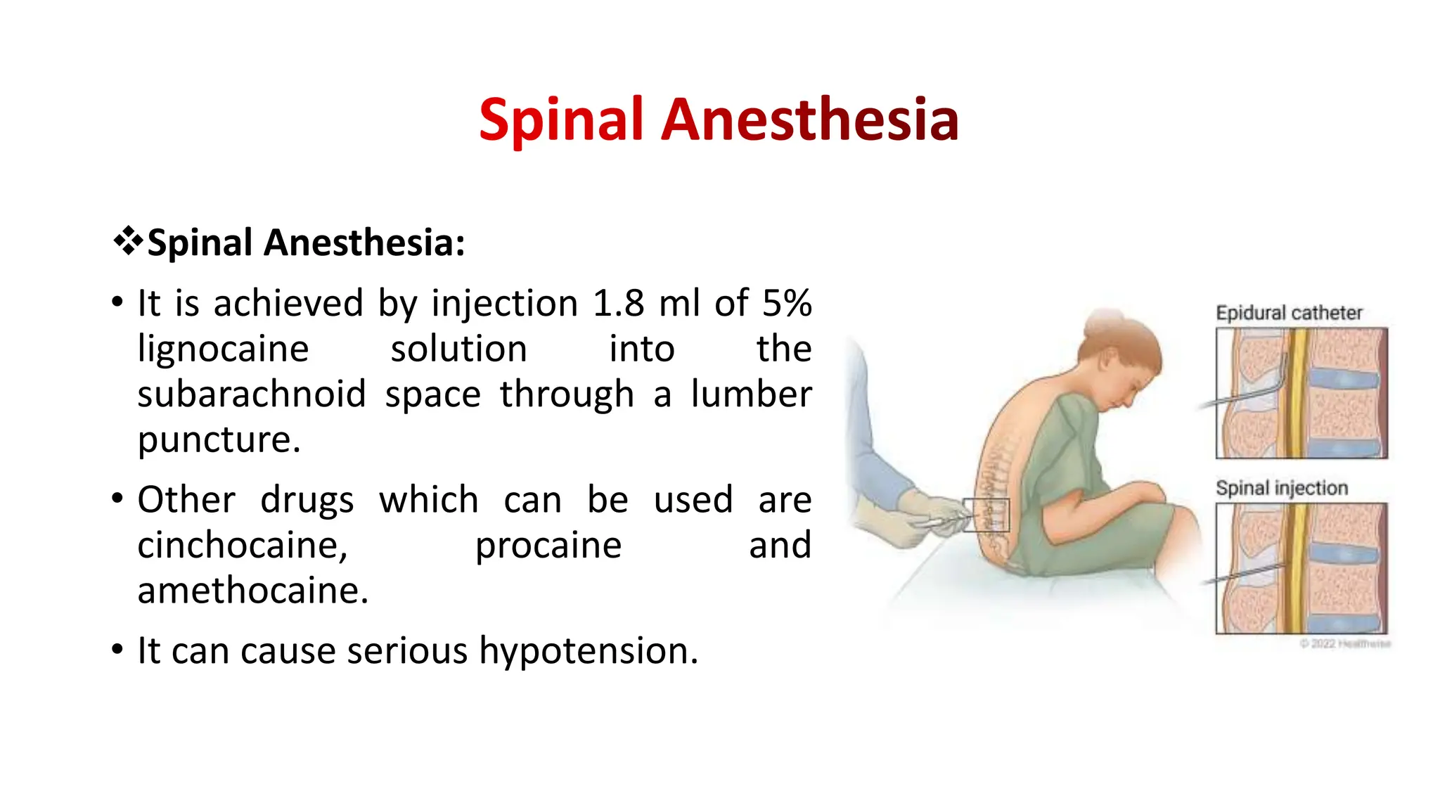 Spinal Anesthesia:
• It is achieved by injection 1.8 ml of 5%
lignocaine solution into the
subarachnoid space through a lumber
puncture.
• Other drugs which can be used are
cinchocaine, procaine and
amethocaine.
• It can cause serious hypotension.
 
