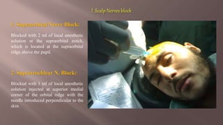 1. Supraorbital Nerve Block:
Blocked with 2 ml of local anesthetic
solution at the supraorbital notch,
which is located at the supraorbital
ridge above the pupil.
2. Supratrochlear N. Block:
Blocked with 1 ml of local anesthetic
solution injected at superior medial
corner of the orbital ridge with the
needle introduced perpendicular to the
skin.
 
