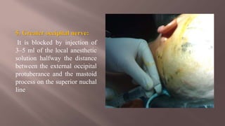 5. Greater occipital nerve:
It is blocked by injection of
3–5 ml of the local anesthetic
solution halfway the distance
between the external occipital
protuberance and the mastoid
process on the superior nuchal
line
 