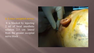 6. Lesser occipital nerve:
It is blocked by injecting
2 ml of local anesthetic
solution 2.5 cm lateral
from the greater occipital
nerve block
 