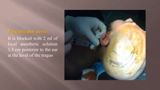 Postauricular nerve:
It is blocked with 2 ml of
local anesthetic solution
1.5 cm posterior to the ear
at the level of the tragus.
 