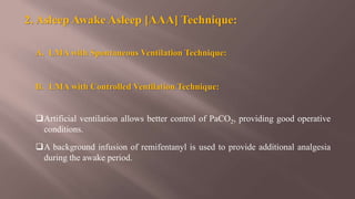 2. Asleep Awake Asleep [AAA] Technique:
A. LMA with Spontaneous Ventilation Technique:
B. LMA with Controlled Ventilation Technique:
Artificial ventilation allows better control of PaCO2, providing good operative
conditions.
A background infusion of remifentanyl is used to provide additional analgesia
during the awake period.
 