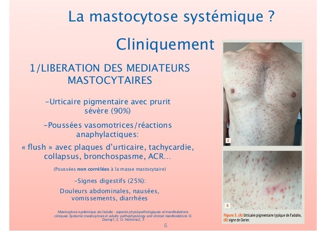 Prise en charge anesthésique des mastocytoses systémiques