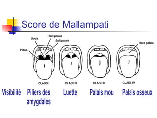 Evaluation préopératoire Mortalité péri-opératoire Mortalité totalement liée à l’anesthésie: 1/150 000 anesthésies 