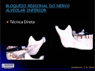    Técnica Direta
 