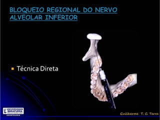    Técnica Direta
 