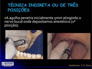 A agulha penetra inicialmente 5mm atingindo o
nervo bucal onde depositamos anestésico (1ª
posição);
 