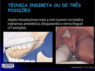 Após introduzimos mais 5 mm (10mm no total) e
injetamos anestésico, bloqueando o nervo lingual
(2ª posição);
 