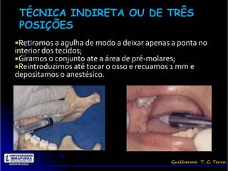 Retiramos a agulha de modo a deixar apenas a ponta no
interior dos tecidos;
Giramos o conjunto ate a área de pré-molares;
Reintroduzimos até tocar o osso e recuamos 1 mm e
depositamos o anestésico.
 