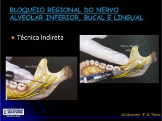    Técnica Indireta
 