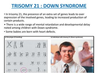 TRISOMY 21 : DOWN SYNDROME
• In trisomy 21, the presence of an extra set of genes leads to over
expression of the involved genes, leading to increased production of
certain products.
• There is a wide range of mental retardation and developmental delay
noted among children with Down syndrome.
• Some babies are born with heart defects.
 