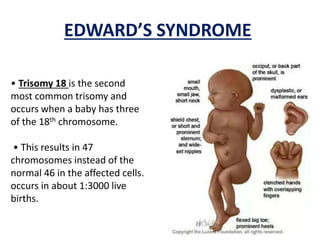 EDWARD’S SYNDROME
• Trisomy 18 is the second
most common trisomy and
occurs when a baby has three
of the 18th chromosome.
• This results in 47
chromosomes instead of the
normal 46 in the affected cells.
occurs in about 1:3000 live
births.
 