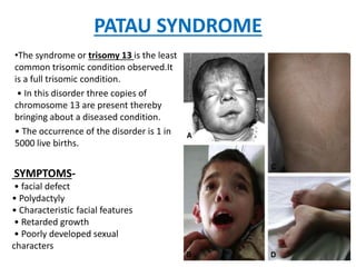 PATAU SYNDROME
•The syndrome or trisomy 13 is the least
common trisomic condition observed.It
is a full trisomic condition.
• In this disorder three copies of
chromosome 13 are present thereby
bringing about a diseased condition.
• The occurrence of the disorder is 1 in
5000 live births.
SYMPTOMS-
• facial defect
• Polydactyly
• Characteristic facial features
• Retarded growth
• Poorly developed sexual
characters
 