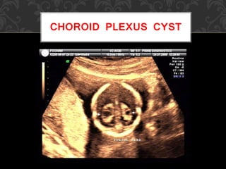 CHOROID PLEXUS CYST
 