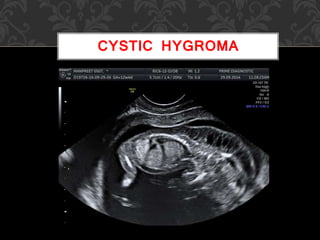 CYSTIC HYGROMA
 