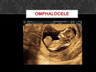 OMPHALOCELE
 