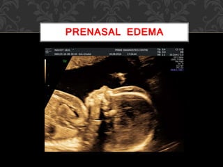 PRENASAL EDEMA
 