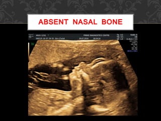 ABSENT NASAL BONE
 
