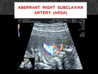 ABERRANT RIGHT SUBCLAVIAN
ARTERY (ARSA)
 