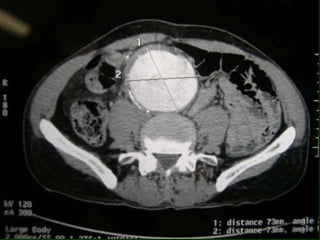Aneurisma de aorta abdominal | PPTX
