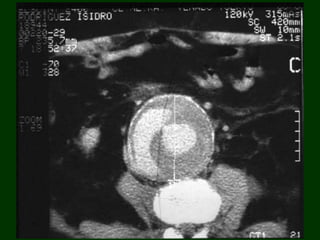 Aneurisma de aorta abdominal | PPTX