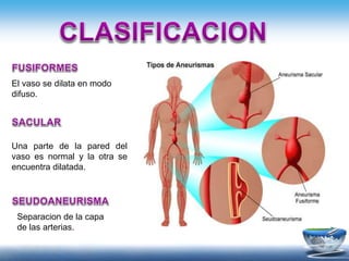 El vaso se dilata en modo
difuso.
Una parte de la pared del
vaso es normal y la otra se
encuentra dilatada.
Separacion de la capa
de las arterias.
 