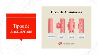Tipos de
aneurismas
 