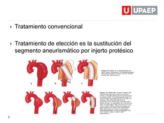 Aneurisma aórtico-y-abdominal | PPTX