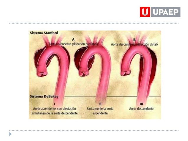 Aneurisma aórtico-y-abdominal