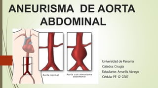 ANEURISMA DE AORTA
ABDOMINAL
Universidad de Panamá
Cátedra: Cirugía
Estudiante: Amarilis Abrego
Cédula: PE-12-2207
 