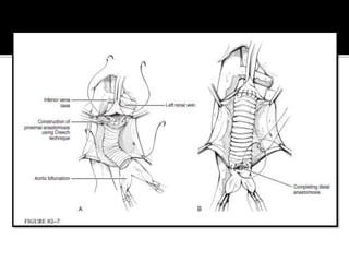 Aneurisma aortico abdominal | PPTX