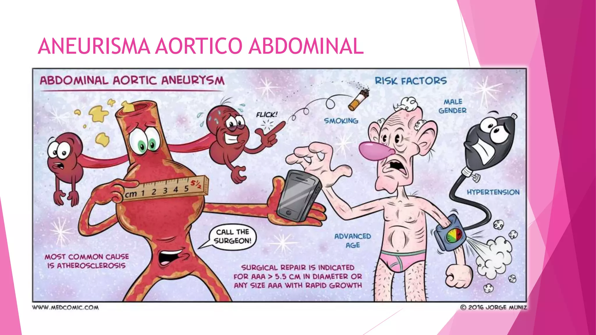 Aneurisma aortico abdominal | PPTX