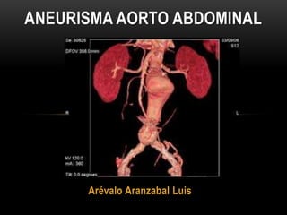 Arévalo Aranzabal Luis
ANEURISMA AORTO ABDOMINAL
 