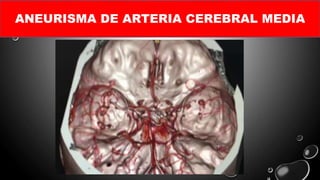 ANEURISMA DE ARTERIA CEREBRAL MEDIA
 