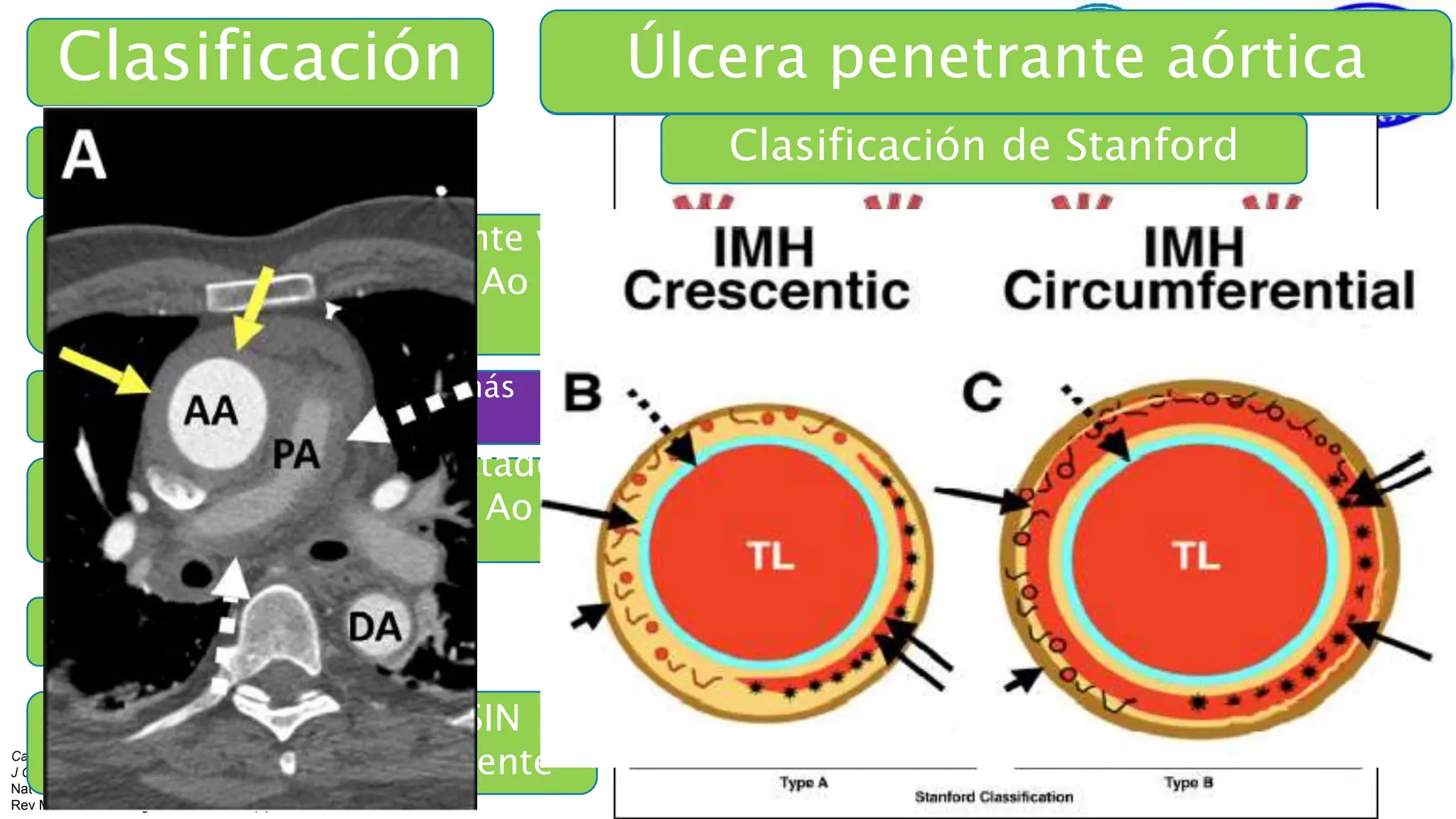 Aneurisma aórtico torácico y Síndromes aórticos Agudos Corregido 1.pptx
