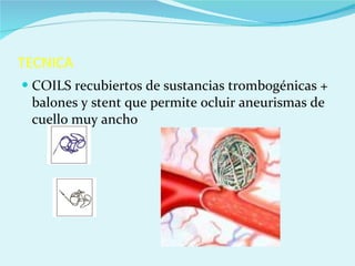 TECNICA COILS recubiertos de sustancias trombogénicas + balones y stent que permite ocluir aneurismas de cuello muy ancho 