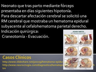Neonato que tras parto mediante fórceps
presentaba en días siguientes hipotonía.
Para descartar afectación cerebral se solicitó una
RM cerebral que mostraba un hematoma epidural
subyacente al cefalohematoma parietal derecho.
Indicación quirúrgica:
 Craneotomía - Evacuación.
 