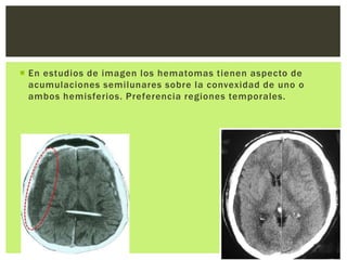  En estudios de imagen los hematomas tienen aspecto de
  acumulaciones semilunares sobre la convexidad de uno o
  ambos hemisferios. Preferencia regiones temporales.
 
