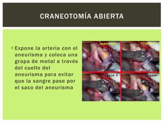 CRANEOTOMÍA ABIERTA



 Expone la arteria con el
  aneurisma y coloca una
  grapa de metal a través
  del cuello del
  aneurisma para evitar
  que la sangre pase por
  el saco del aneurisma
 