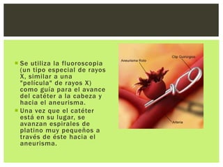  Se utiliza la fluoroscopia
  (un tipo especial de rayos
  X, similar a una
  "película" de rayos X)
  como guía para el avance
  del catéter a la cabeza y
  hacia el aneurisma.
 Una vez que el catéter
  está en su lugar, se
  avanzan espirales de
  platino muy pequeños a
  través de éste hacia el
  aneurisma.
 