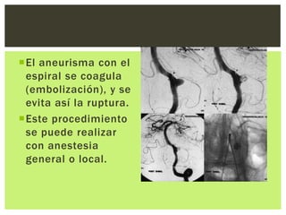 El aneurisma con el
 espiral se coagula
 (embolización), y se
 evita así la ruptura.
Este procedimiento
 se puede realizar
 con anestesia
 general o local.
 