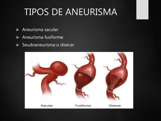 TIPOS DE ANEURISMA
 Aneurisma sacular
 Aneurisma fusiforme
 Seudoaneurisma o disecar
 