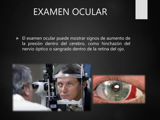 EXAMEN OCULAR
 El examen ocular puede mostrar signos de aumento de
la presión dentro del cerebro, como hinchazón del
nervio óptico o sangrado dentro de la retina del ojo.
 