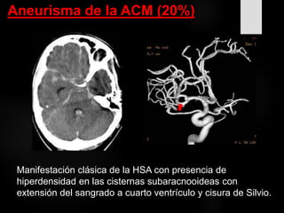 Manifestación clásica de la HSA con presencia de
hiperdensidad en las cisternas subaracnooideas con
extensión del sangrado a cuarto ventrículo y cisura de Silvio.
Aneurisma de la ACM (20%)
 