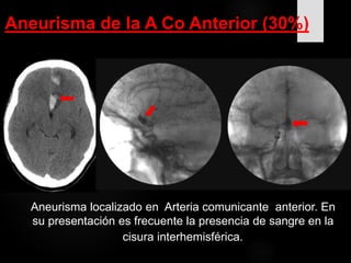 Aneurisma localizado en Arteria comunicante anterior. En
su presentación es frecuente la presencia de sangre en la
cisura interhemisférica.
Aneurisma de la A Co Anterior (30%)
 