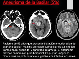 Aneurisma de la Basilar (5%)
Paciente de 55 años que presenta dilatación aneurismática de
la arteria basilar máxima en región suprasellar de 3.5 cm con
trombo mural asociado y sangrado intramural. El aneurisma
provoca compresión protuberancial. Pequeñas imágenes
hipodensas en protuberancia sugestivas de infartos lacunares.
 