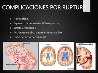 COMPLICACIONES POR RUPTURA
 Hidrocefalia.
 Espasmo de las arterias (Vasoespasmo)
 Infartos cerebrales.
 Accidente cerebro vascular hemorrágico
 Daño nervioso permanente.
 