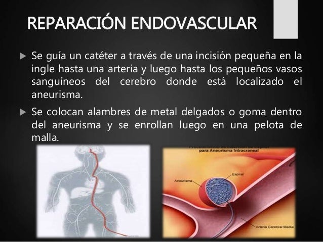 Aneurisma Cerebral