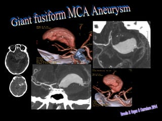 Giant Fusiform Medial Cerebral Artery Aneurysm