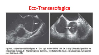 Eco-Transesofagica
 